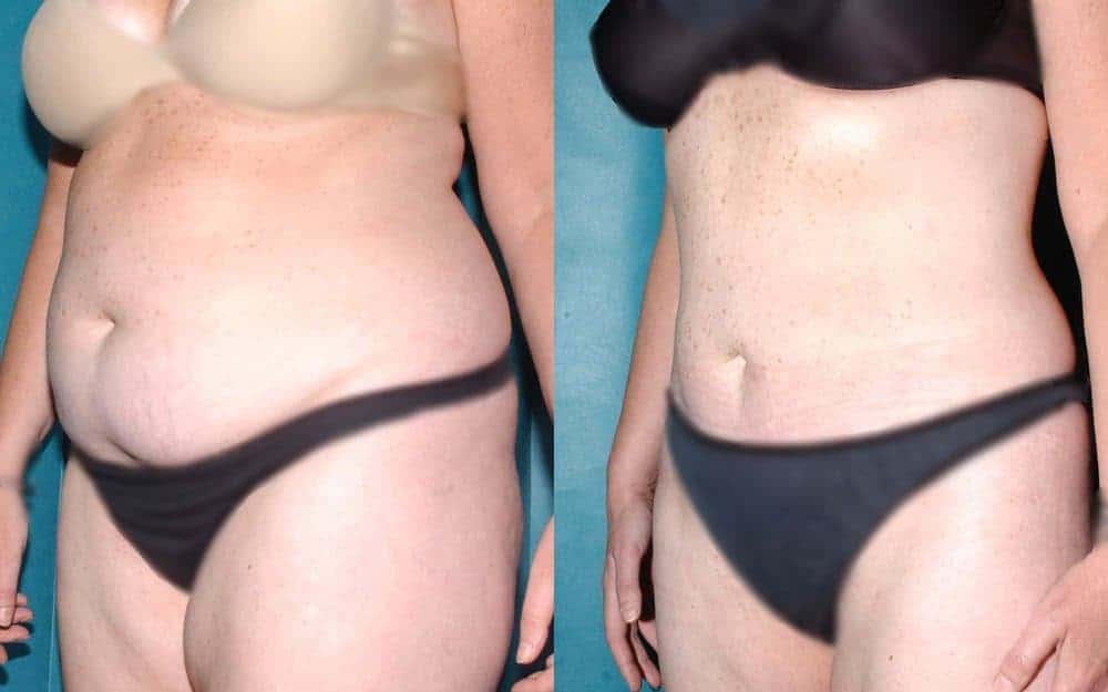 body contouring glasgow edinburgh