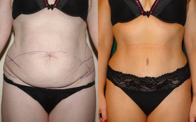 Tummy tuck with muscle tightening
