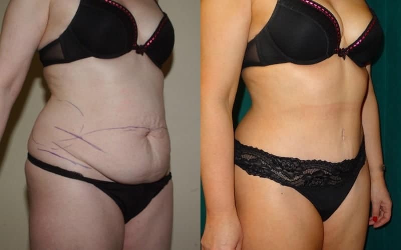 Tummy tuck scotland