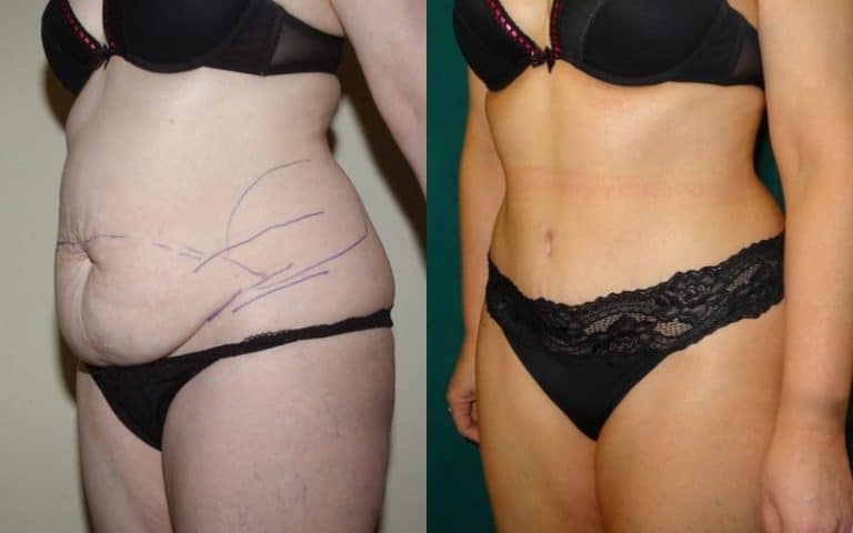 Tummy tuck before and after, case 18, photo 1 of 4