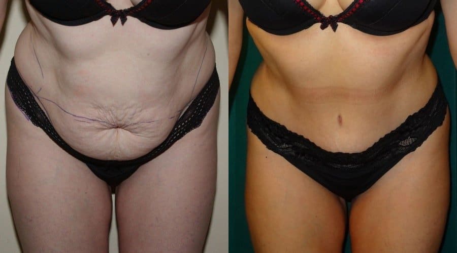 before and after tummy tuck photos