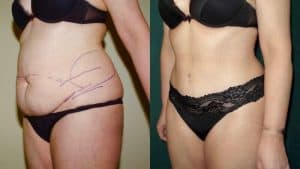 Tummy Tuck Scotland