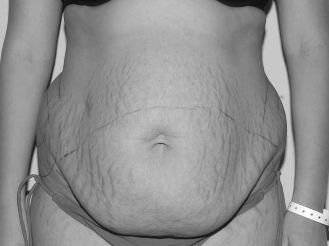 Abdominoplasty - before