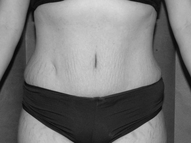 Abdominoplasty - after