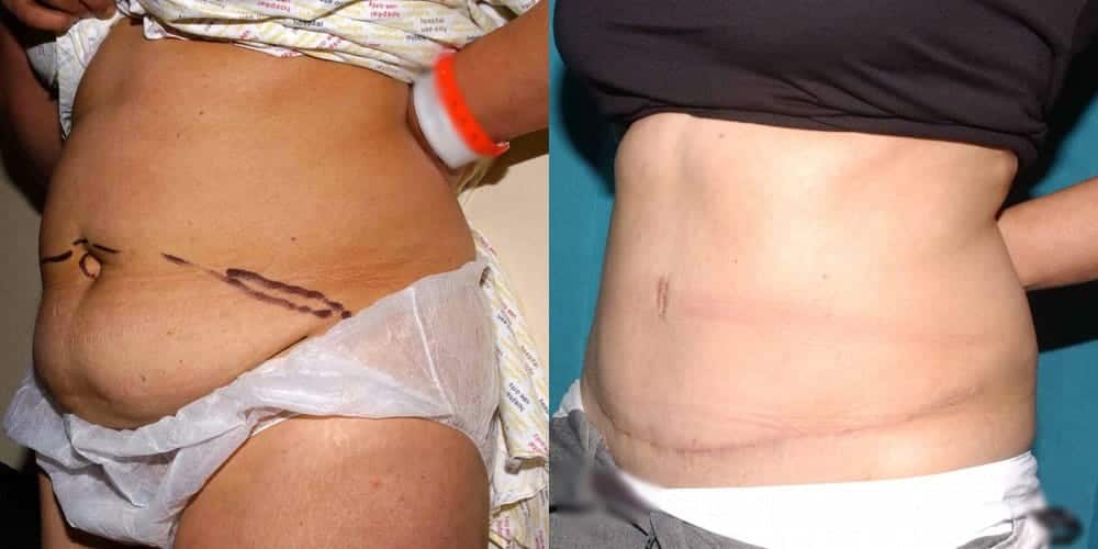 tummy tuck scars uk