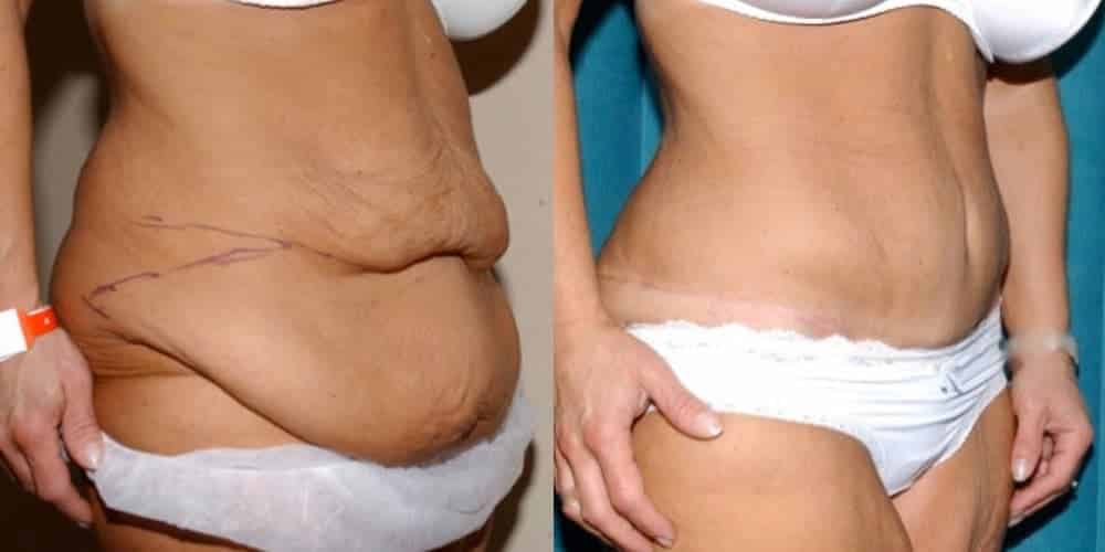 Abdominoplasty uk