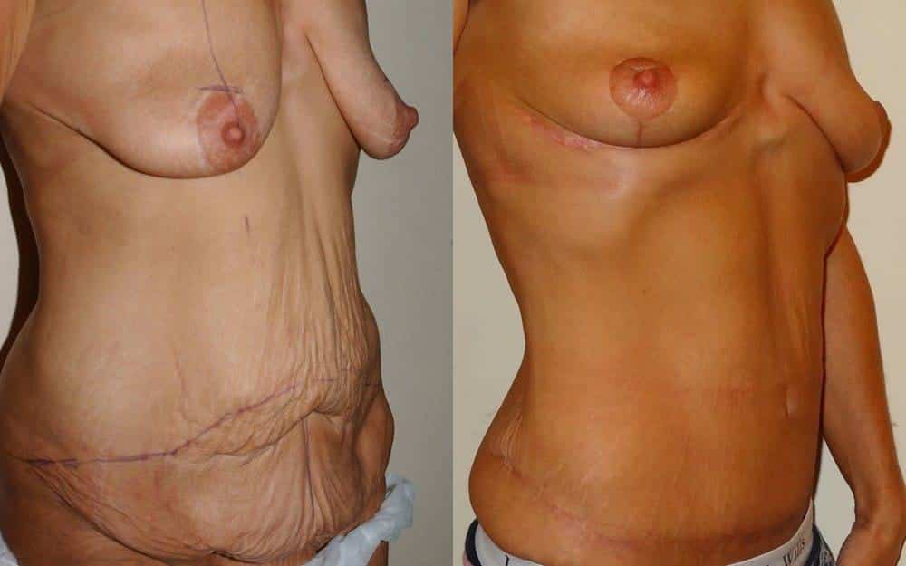 Breast lift and tummy tuck