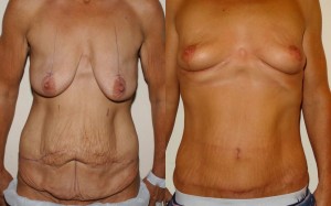 plastic surgery after weight loss