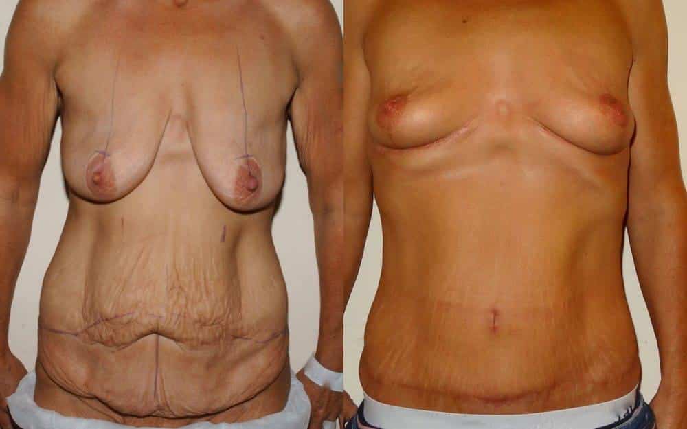 post bariatric plastic surgery scotland