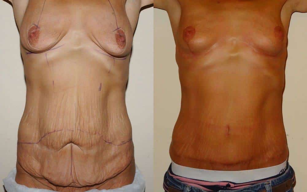 Breast lift and tummy tuck