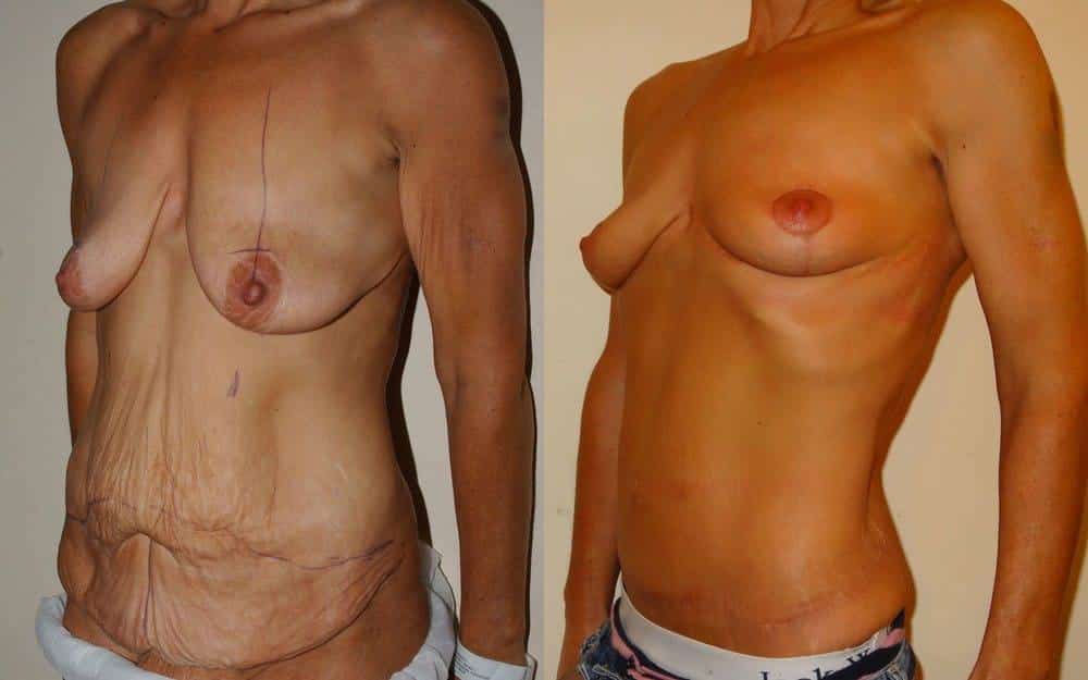 Breast lift and tummy tuck