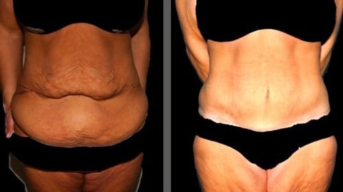 Before and after tummy tuck
