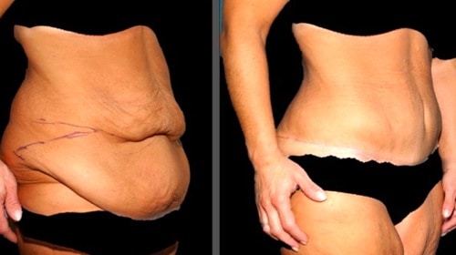 Before and after tummy tuck
