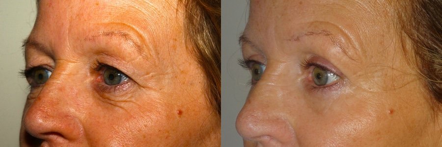 Upper and lower blepharoplasty with fat transfer