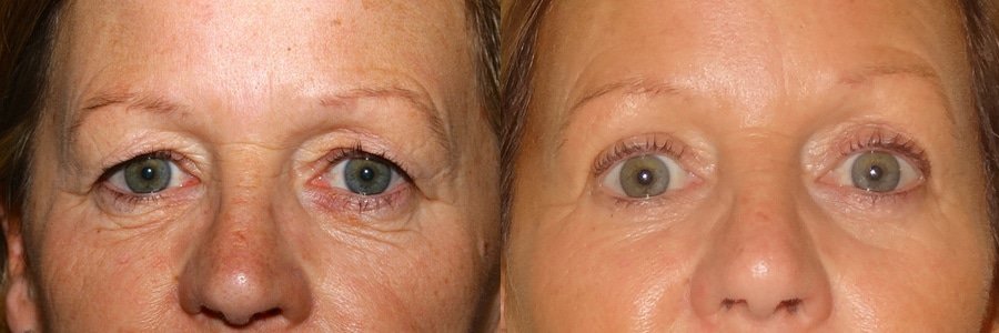 Upper and lower blepharoplasty with fat transfer