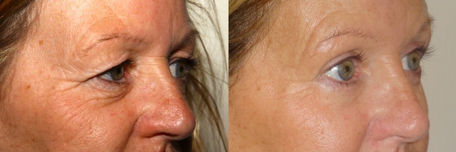 Upper and lower blepharoplasty with fat transfer