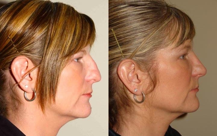 rhinoplasty before and after