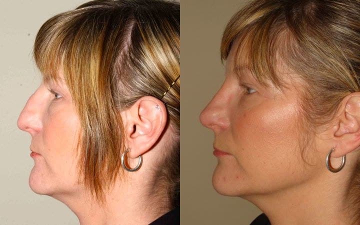 rhinoplasty scotland