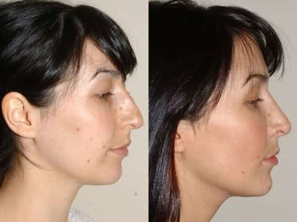 Closed rhinoplasty