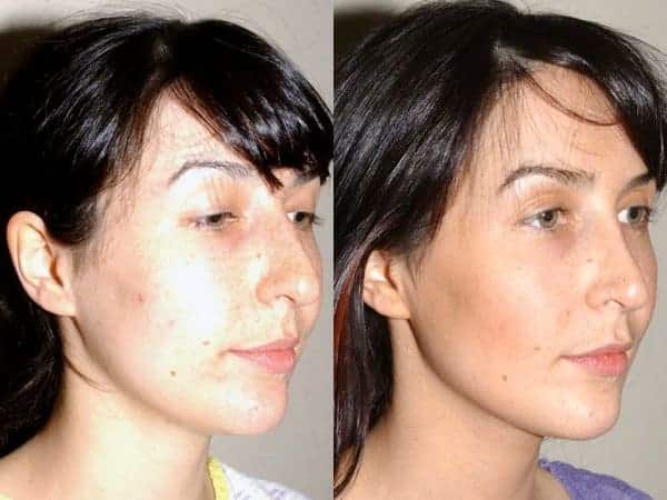 Closed rhinoplasty