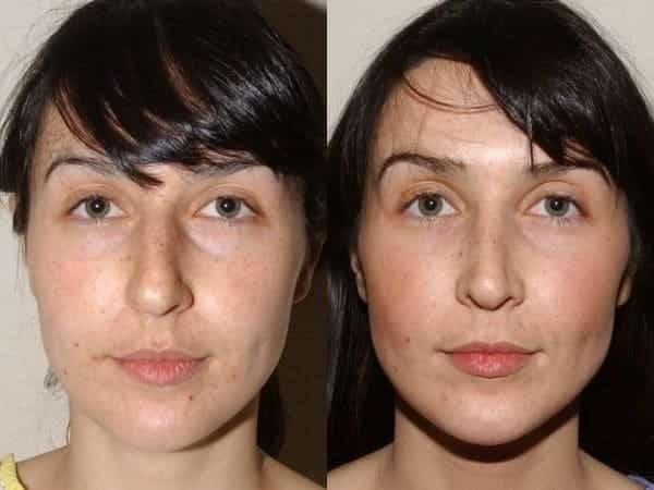 Closed rhinoplasty