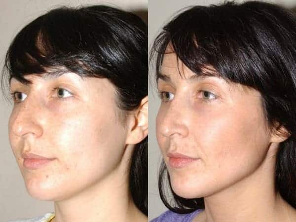 Closed rhinoplasty