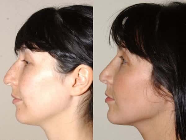 Closed rhinoplasty