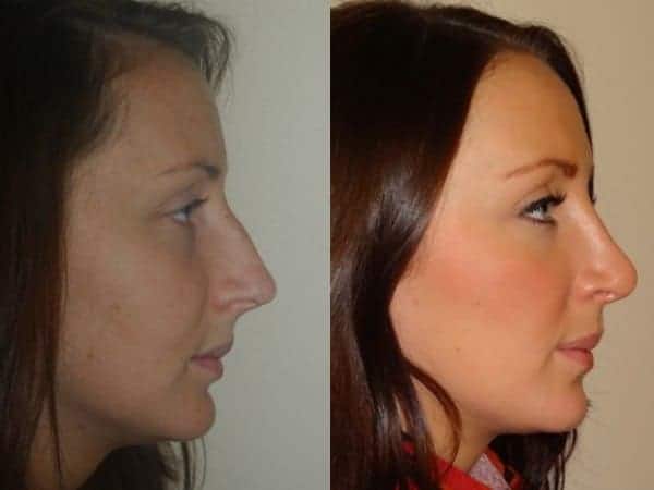 Open rhinoplasty