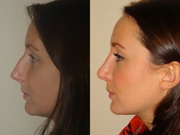 Open rhinoplasty