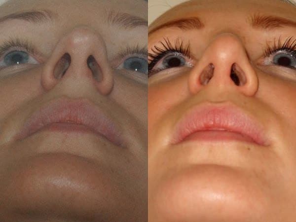 Open rhinoplasty