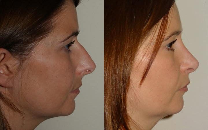 Nose job photos – open rhinoplasty