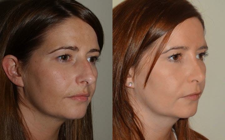 Nose job photos – open rhinoplasty