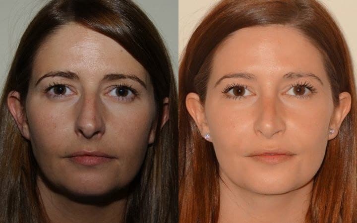 Nose job photos – open rhinoplasty