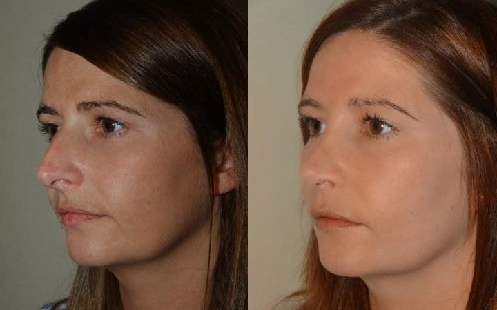 Nose job photos – open rhinoplasty