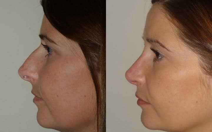 Nose job photos – open rhinoplasty