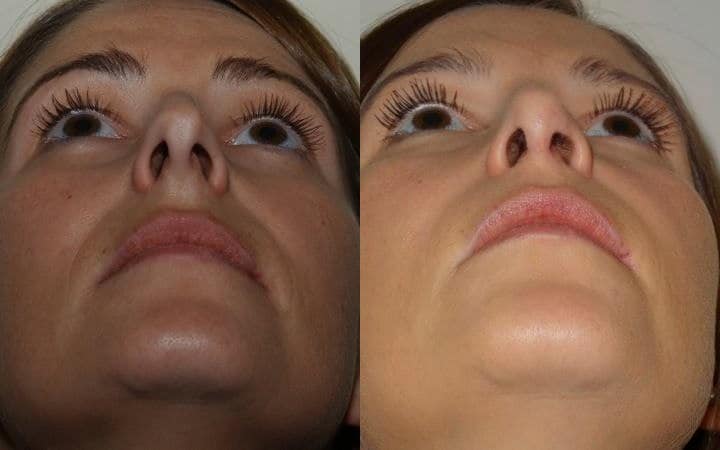 Nose job photos – open rhinoplasty