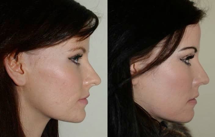 Subtle rhinoplasty to decrease tip projection