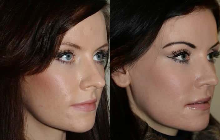 Subtle rhinoplasty to decrease tip projection