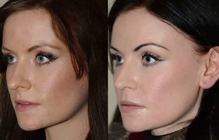 Subtle rhinoplasty to decrease tip projection