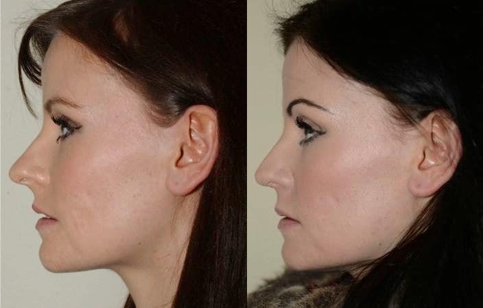 Subtle rhinoplasty to decrease tip projection