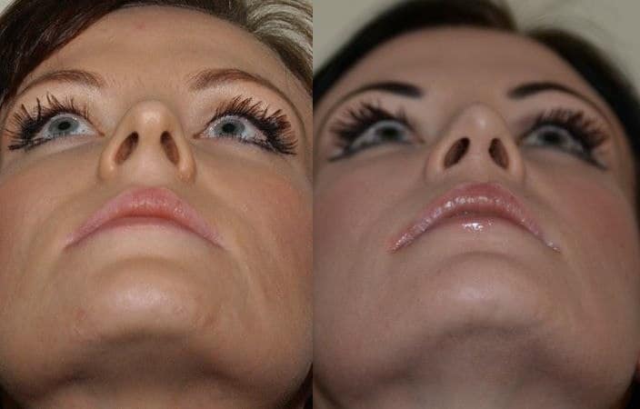 Subtle rhinoplasty to decrease tip projection