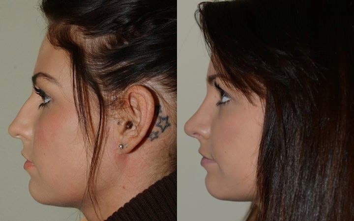 Minor hump reduction and correction of asymmetric tip