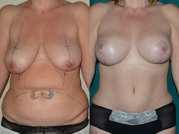 Augmentation mastopexy with tummy tuck