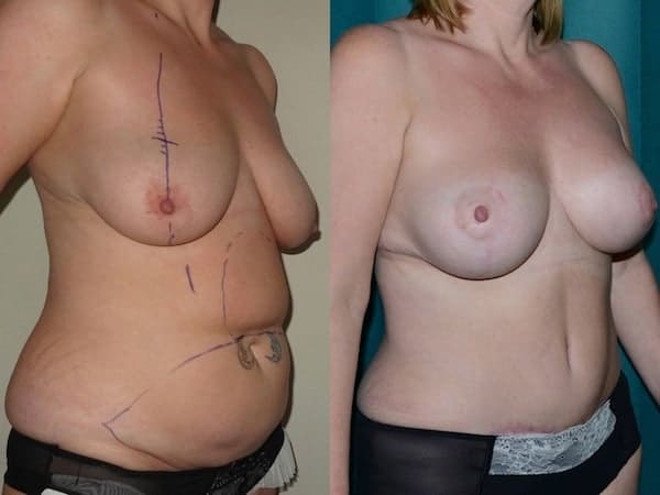 Augmentation mastopexy with tummy tuck