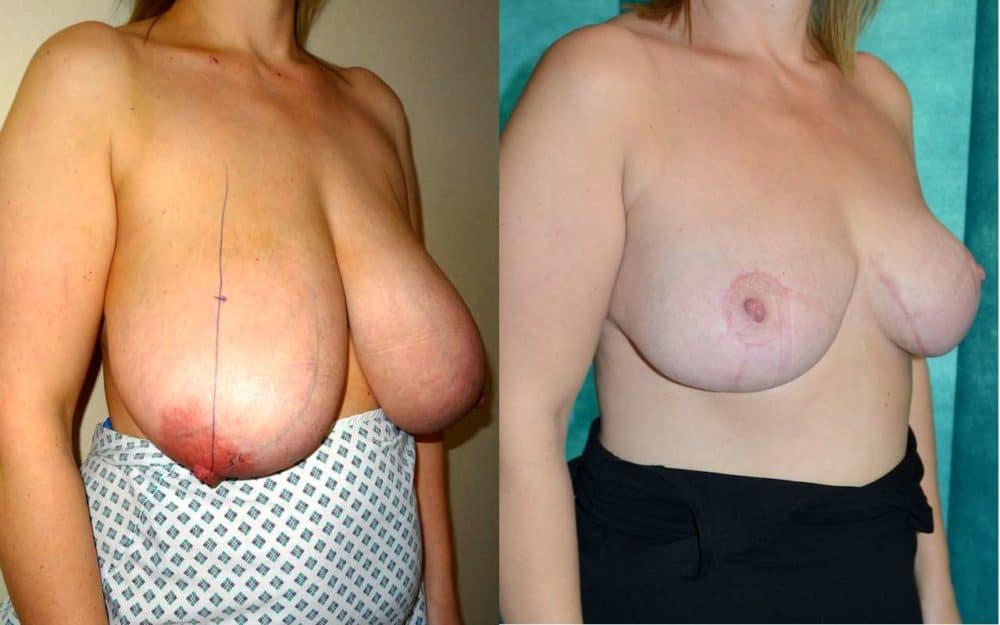 H to DD cup breast reduction photos