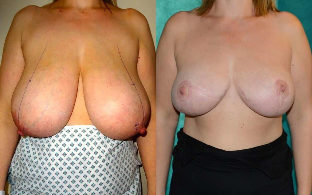 H to DD cup breast reduction photos