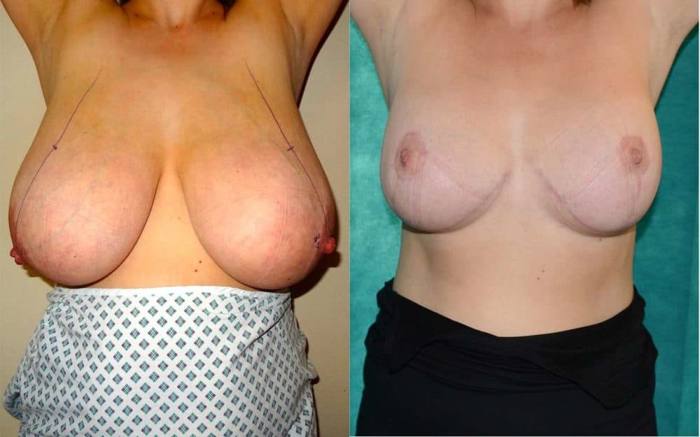 H to DD cup breast reduction photos