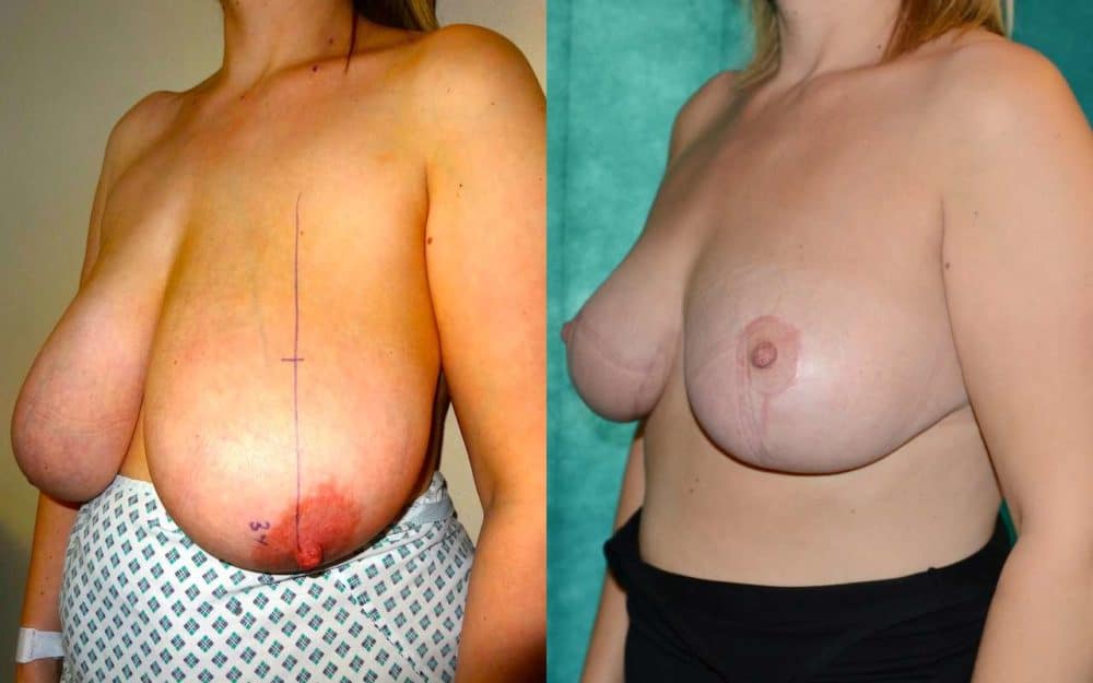 H to DD cup breast reduction photos