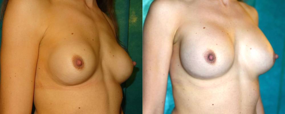 Up-sizing following previous breast augmentation
