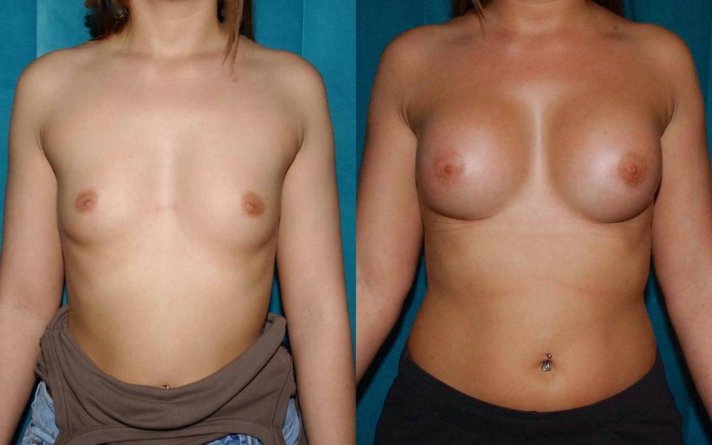 Breast implants and correction of inverted nipples